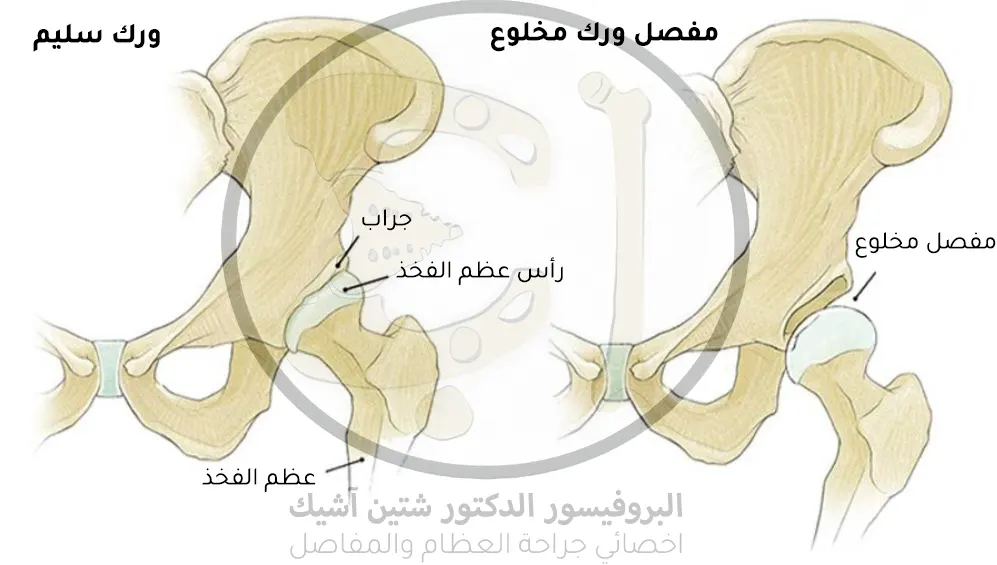 An image showing the difference between a healthy hip and a dislocated hip