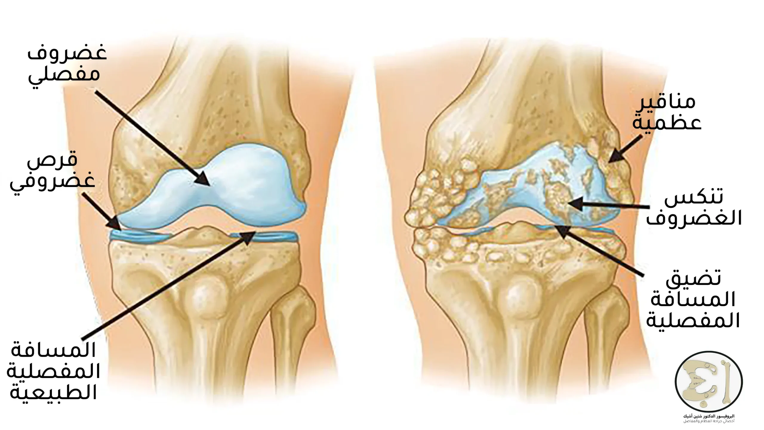 Picture of a healthy knee and an injured knee