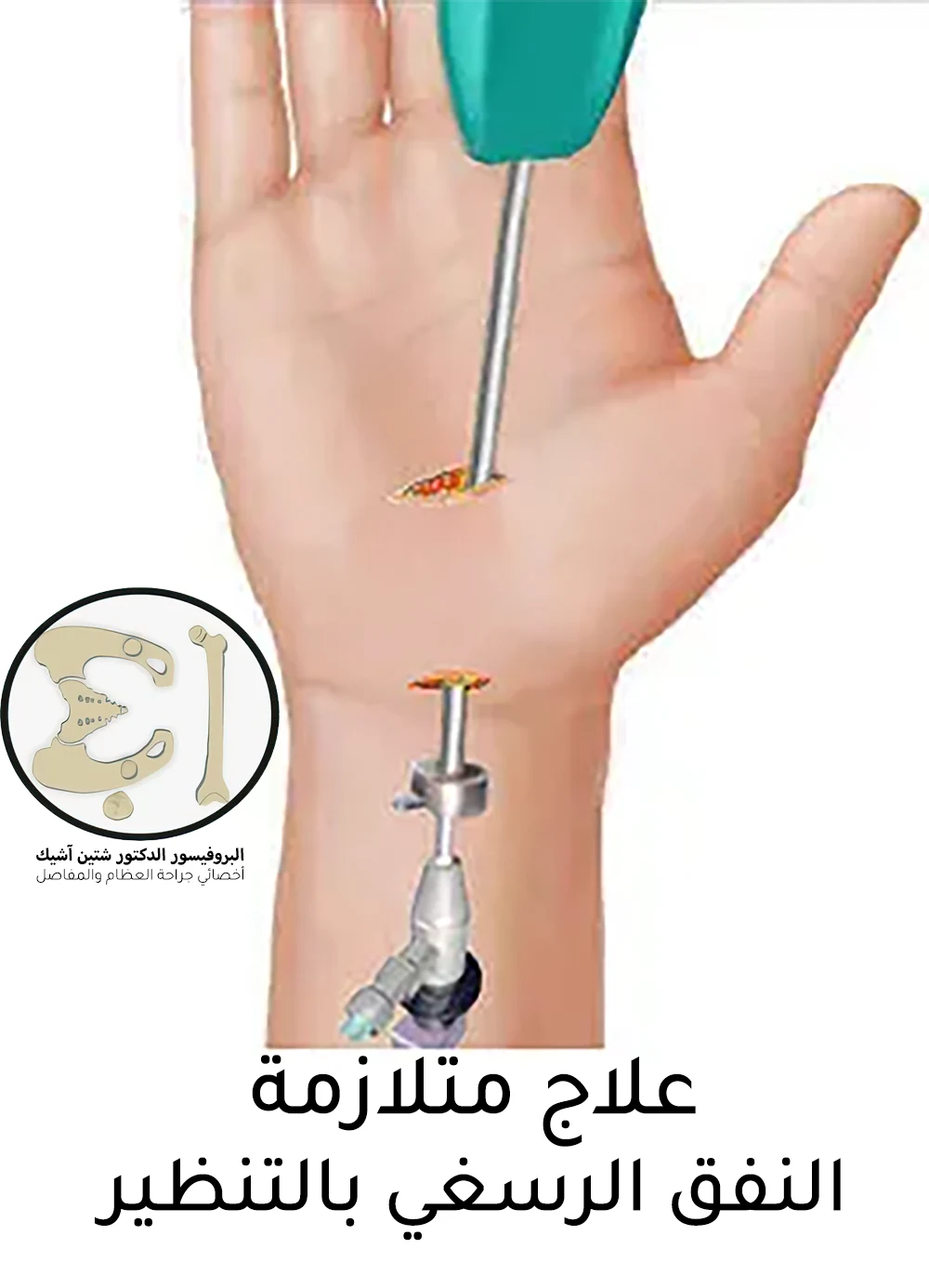 An image showing the endoscopic treatment of carpal tunnel syndrome