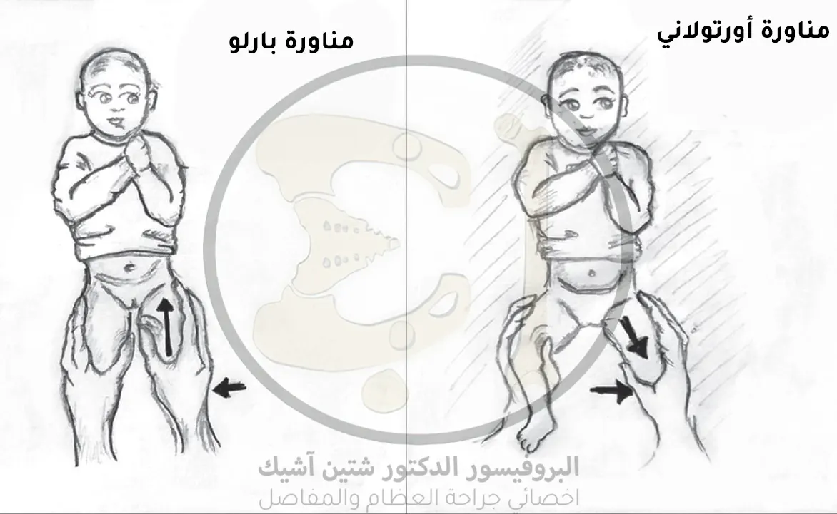 An image showing how the Barlow maneuver is performed, where the examiner applies posterior and lateral pressure to the hip, and the Ortolani maneuver, in which the examiner abducts the thigh and then applies pressure to the proximal part of the femur in a medial direction.