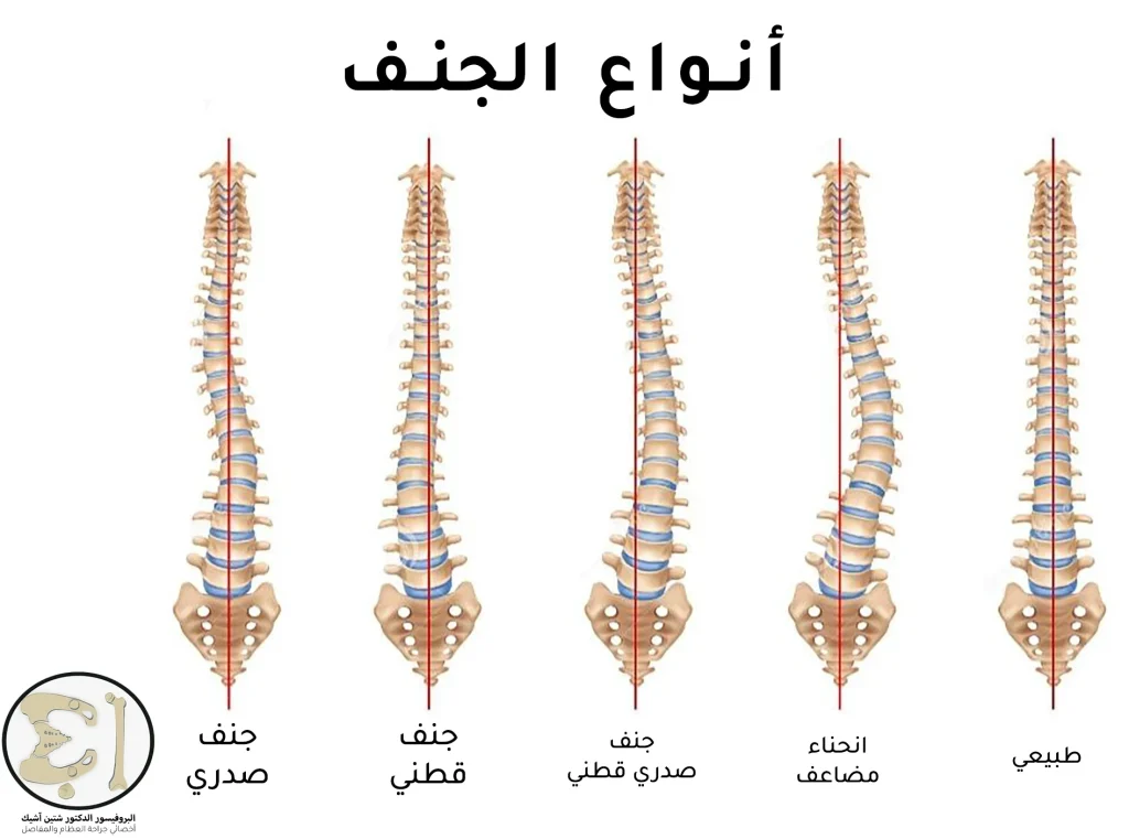 An image showing the different types of scoliosis depending on where it is located. It can affect the thoracic or lumbar region or both. There is also a double curvature type.