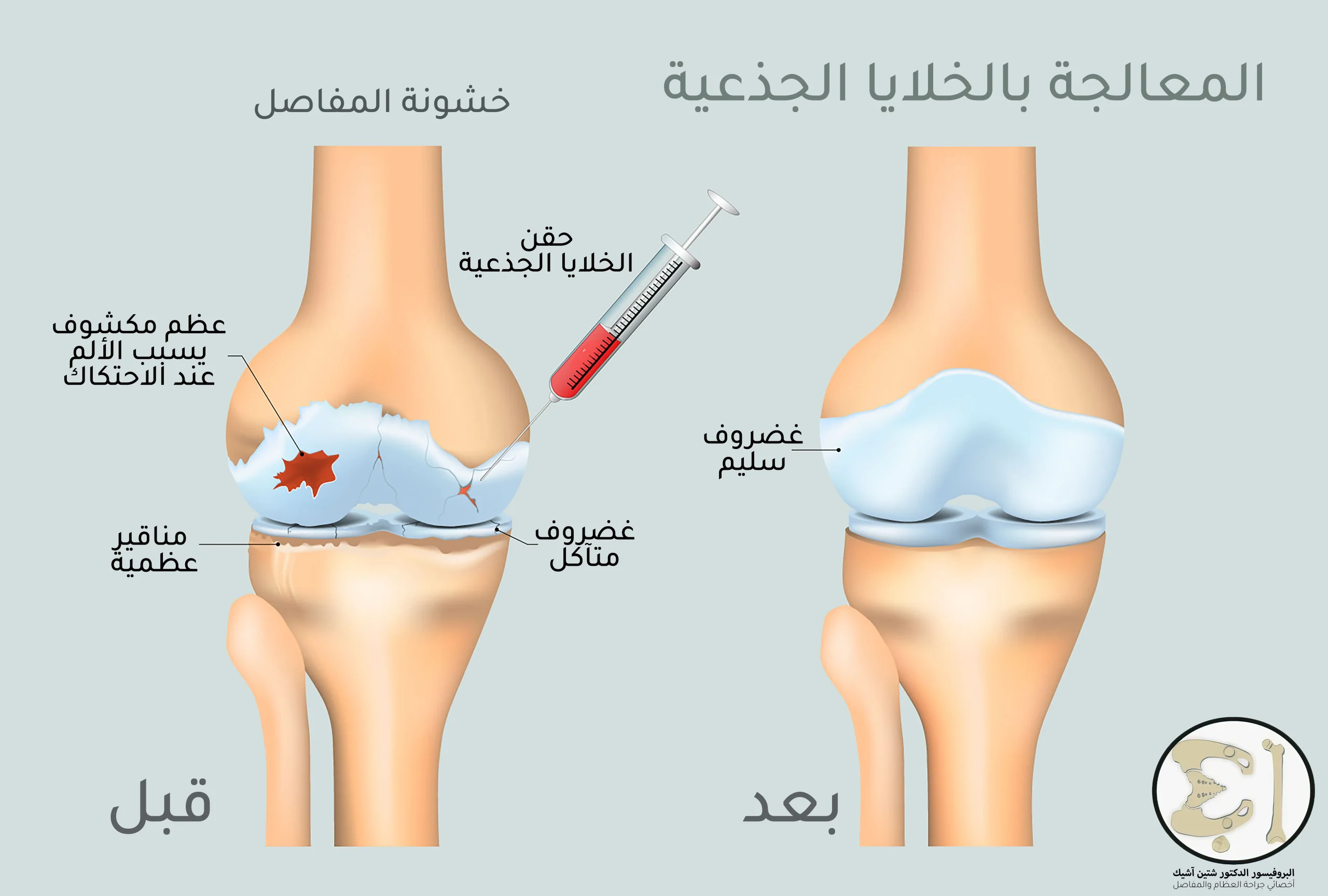 يتم علاج الركبة بالخلايا الجذعية بحقنها ضمن مفصل الركبة المتآكل لإنقاذ ما تبقى من الغضروف أو لإبطاء عملية التنكس