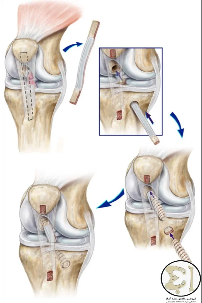 Image showing how to perform anterior cruciate ligament replacement with bone taken from another part of the body using an arthroscope