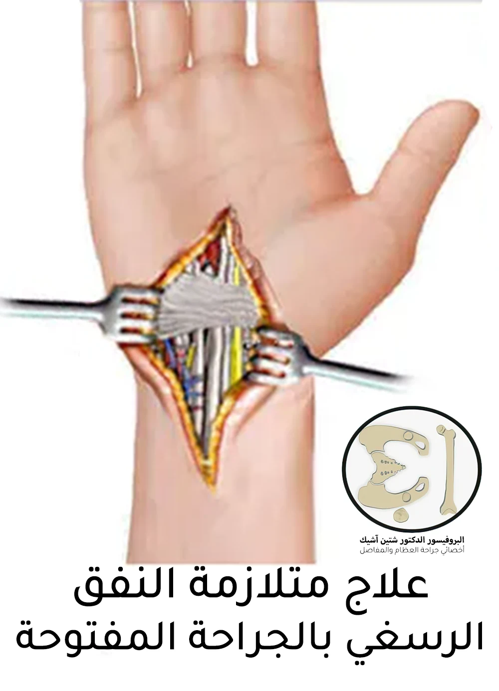 An image showing the treatment of carpal tunnel syndrome with open surgery