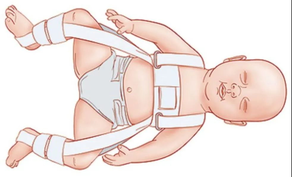 صورة توضح وضعية الطفل المعالج عن طريق الحزام حيث يتم تثبيت الورك المخلوع في مكانه عن طريق ربط الكتف مع القدم
