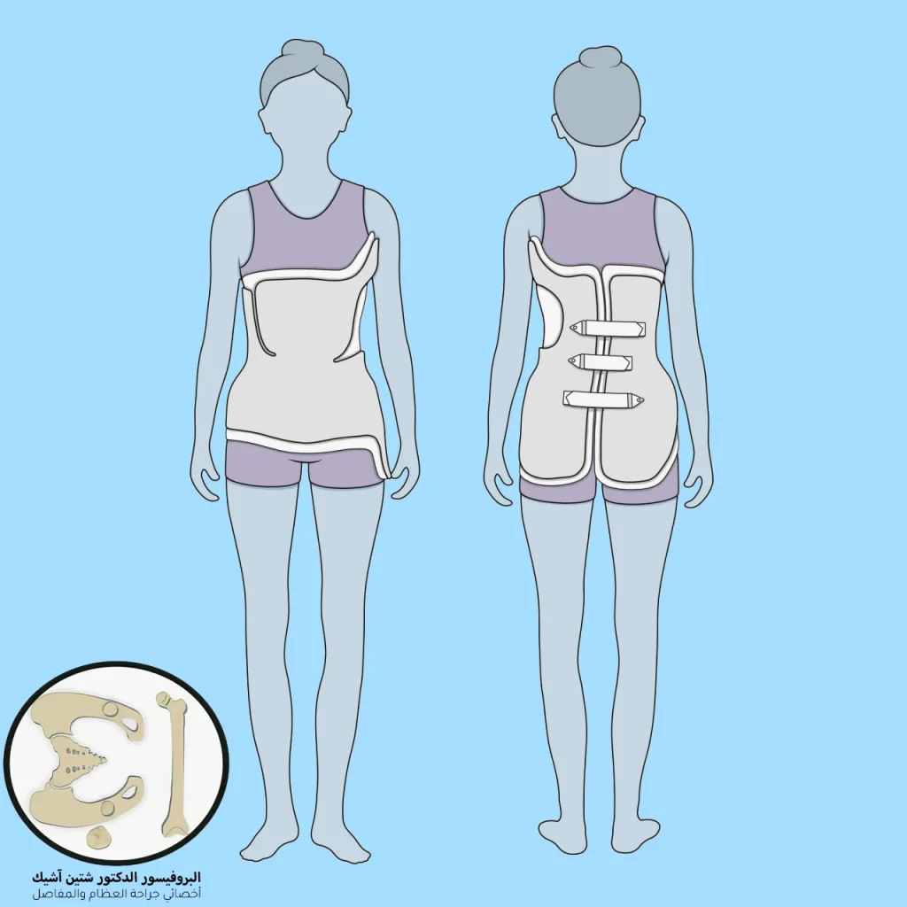 Picture showing how to put the belt that is used to treat scoliosis 