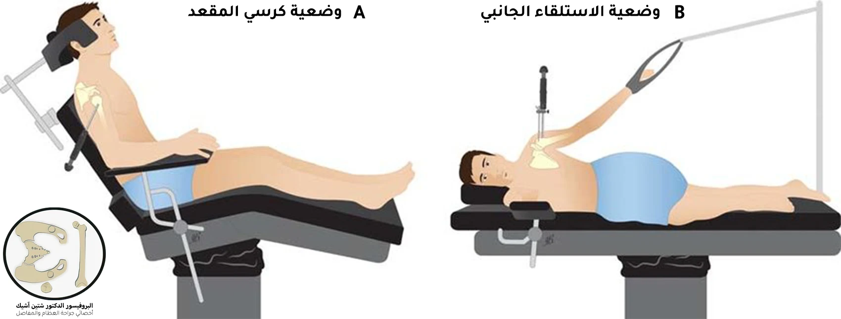 هناك وضعيتين جراحيتين للقيام بعملية الكتف بالمنظار وهي وضعية الاستلقاء الجانبي ووضعية كرسي المقعد