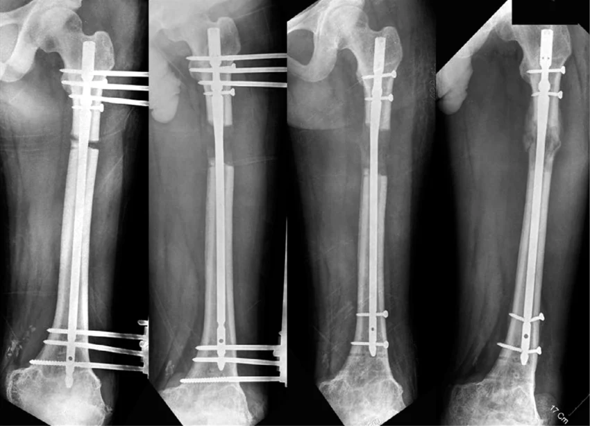 This picture shows the stages of bone lengthening after the operation