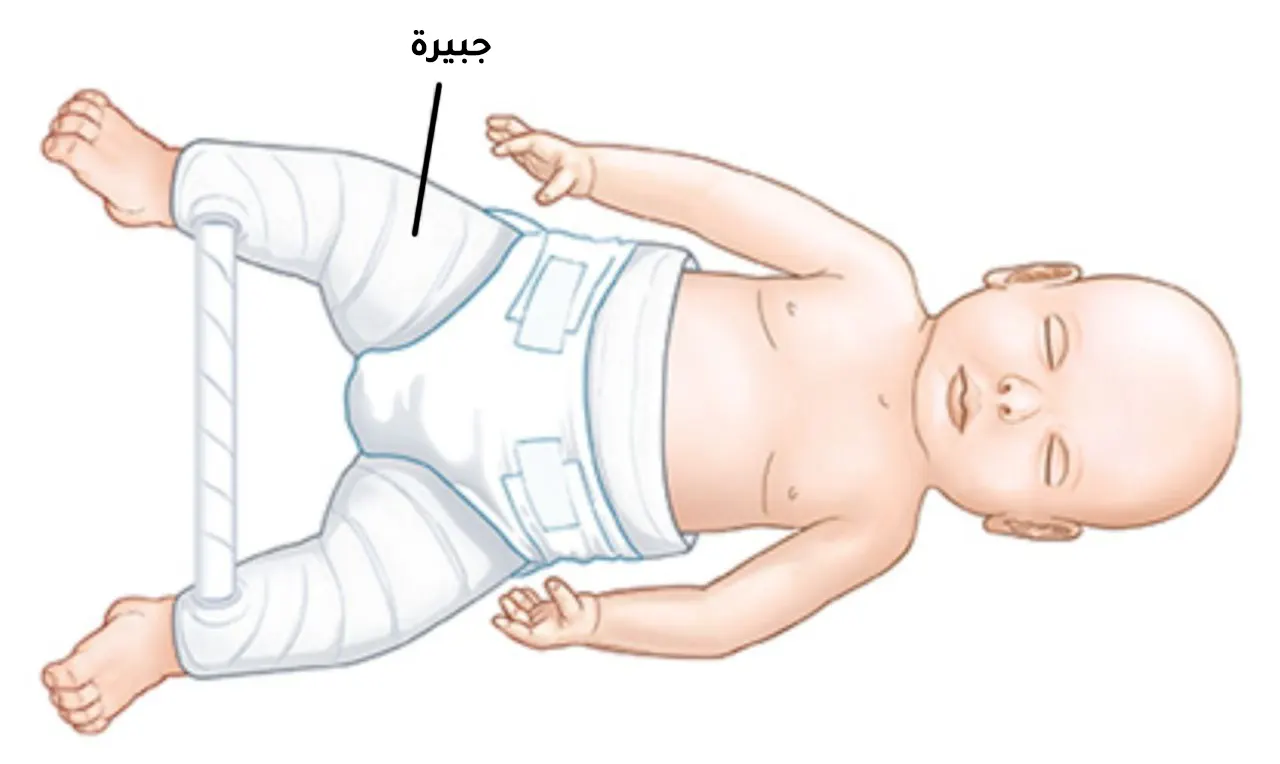 صورة توضح علاج خلع الورك الولادي عن طريق وضع جبيرة لتثبيت الورك المخلوع
