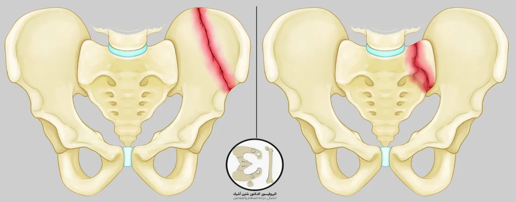 Schematic diagram of a pelvic fracture without separating the bony fragments (stable fracture)