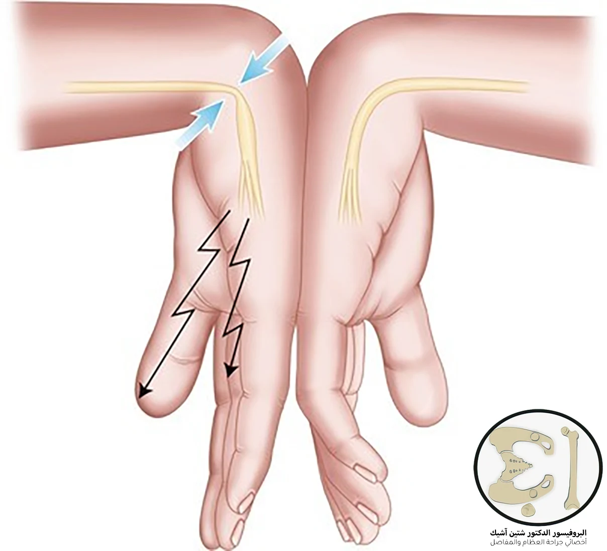 صورة توضح أن ثني اليد قد يحرض نوبة الألم لدى مرضى متلازمة النفق الرسغي