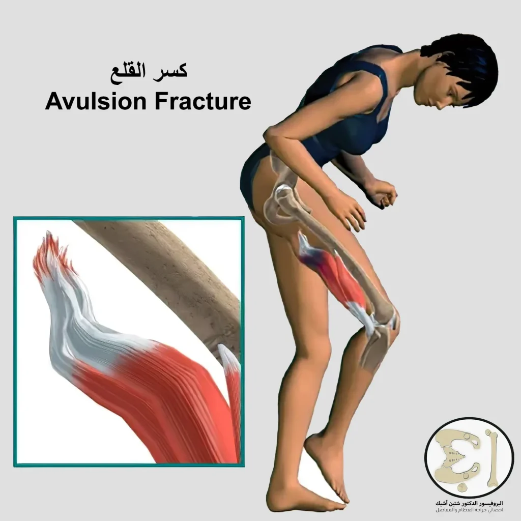 An image showing where and how an extraction fracture occurred