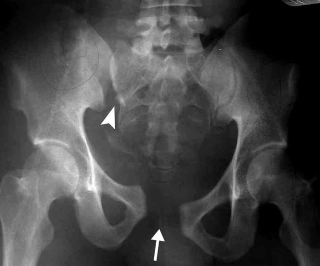 Radiograph showing an unstable fracture of the pelvis