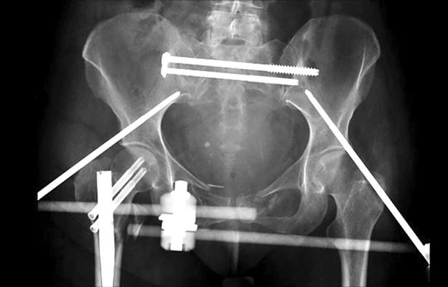 صورة شعاعية توضح علاج كسر الحوض بالإصلاح الخارجي حيث نشاهد تركيب مقومات العظم من أجل تثبيت العظام المكسورة