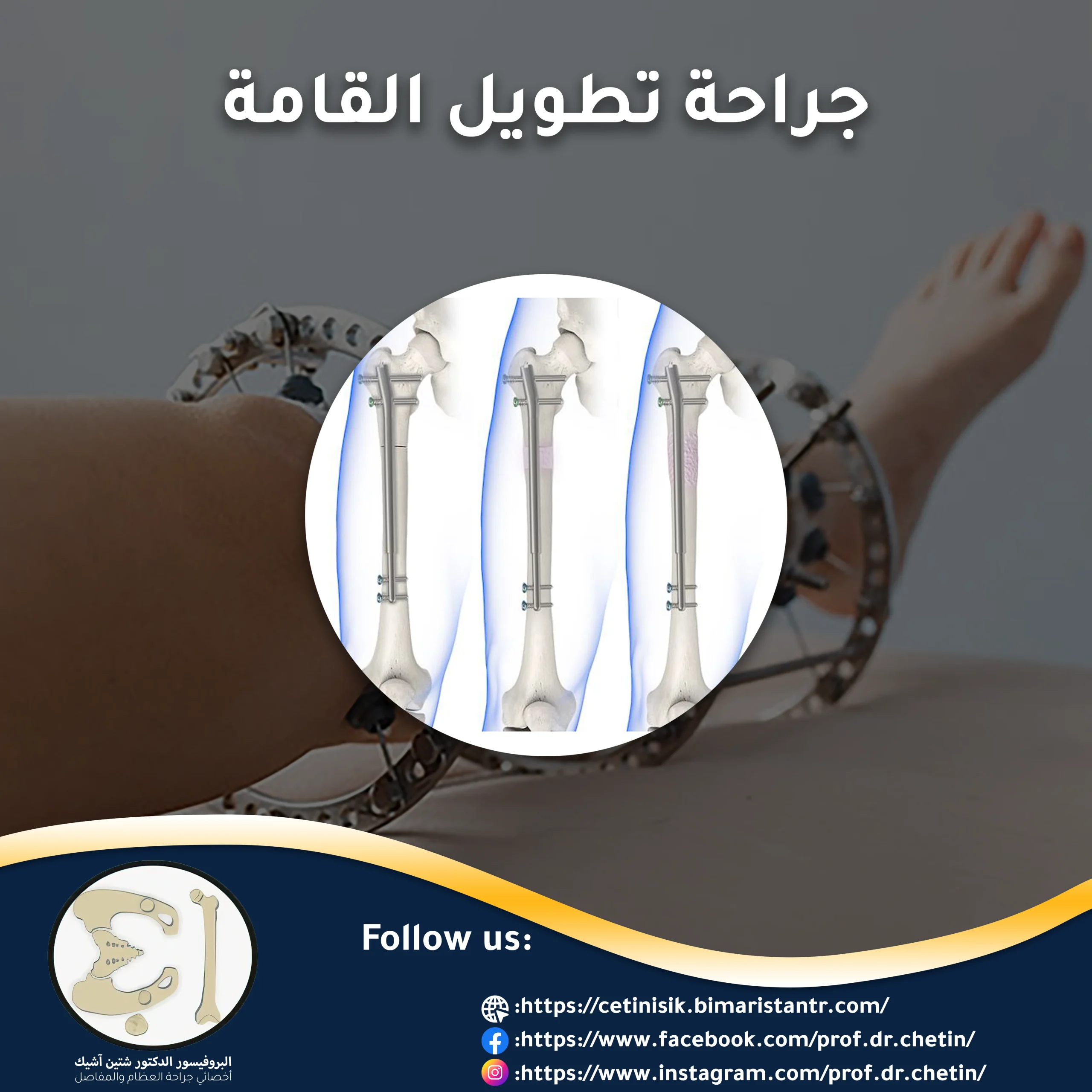 Lengthening surgery