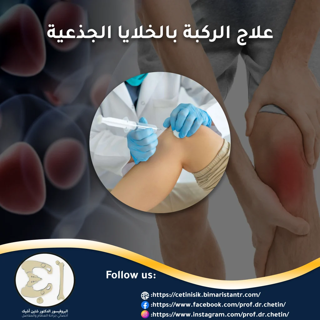 يتم حقن الخلايا الجذعية في مفصل الركبة عند إصابته بأمراض عديدة أشيعها الفصال العظمي.
