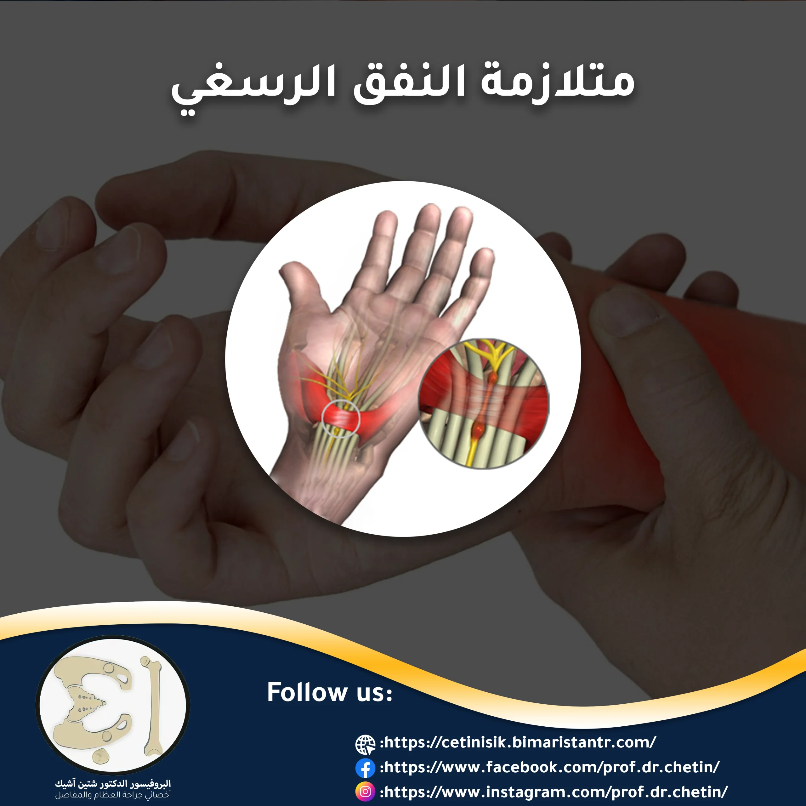What is carpal tunnel syndrome disease