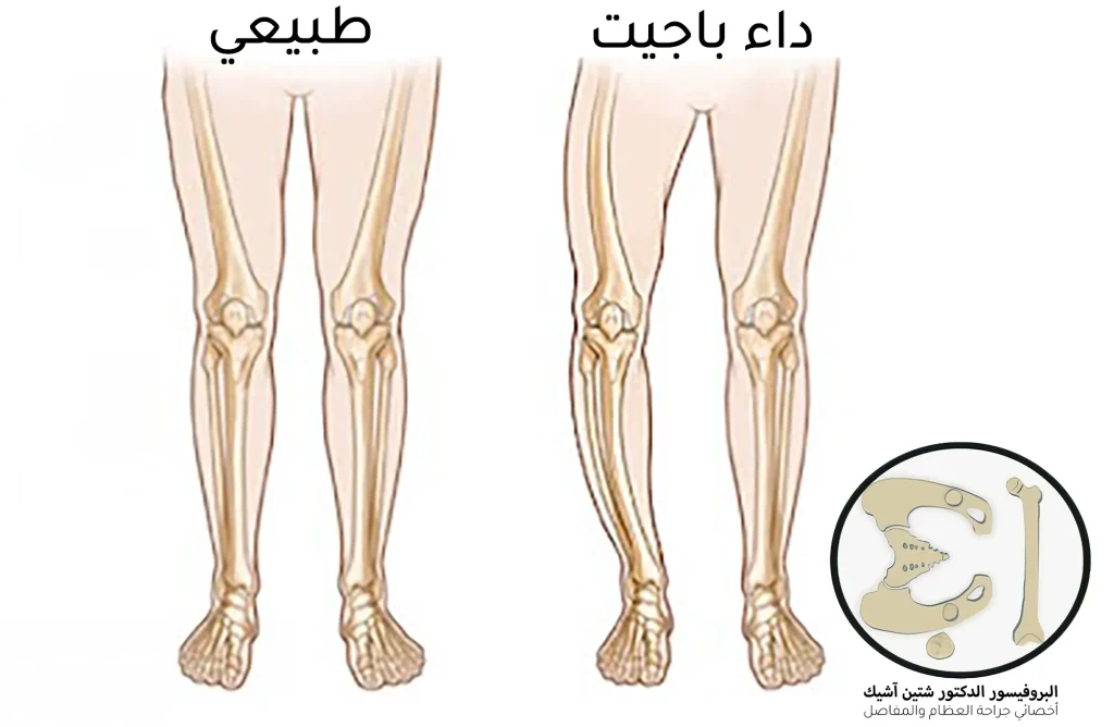 صورة توضيحية عن الفرق بين الساق الطبيعية وفي داء باجيت الذي تنحني فيه العظام الطويلة