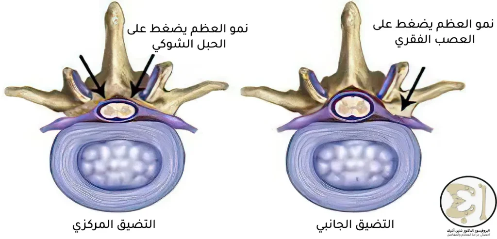 يظهر الرسم التوضيحي الفرق بين التضيق المركزي الضاغط على الحبل الشوكي والتضيق الجانبي الذي يضغط على العصب الفقري