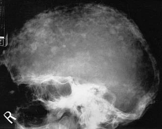الأشعة السينية لجمجمة مصاب بداء باجيت العظمي.