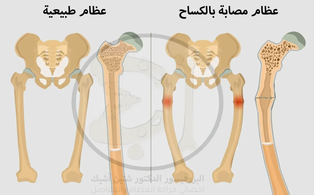 صورة توضح الفرق بين عظام الطفل السليم وعظام الطفل المصاب بالكساح حيث تكون مقوسة وضعيفة