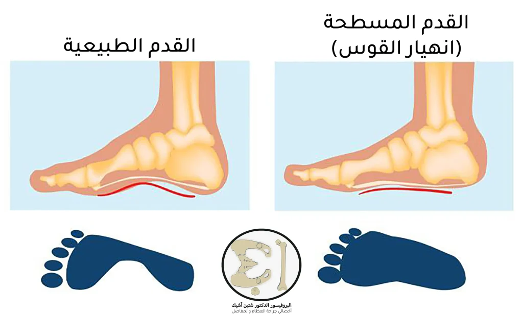 الفرق بين القدم الطبيعية والقدم المسطحة و طبعة كل منهما.