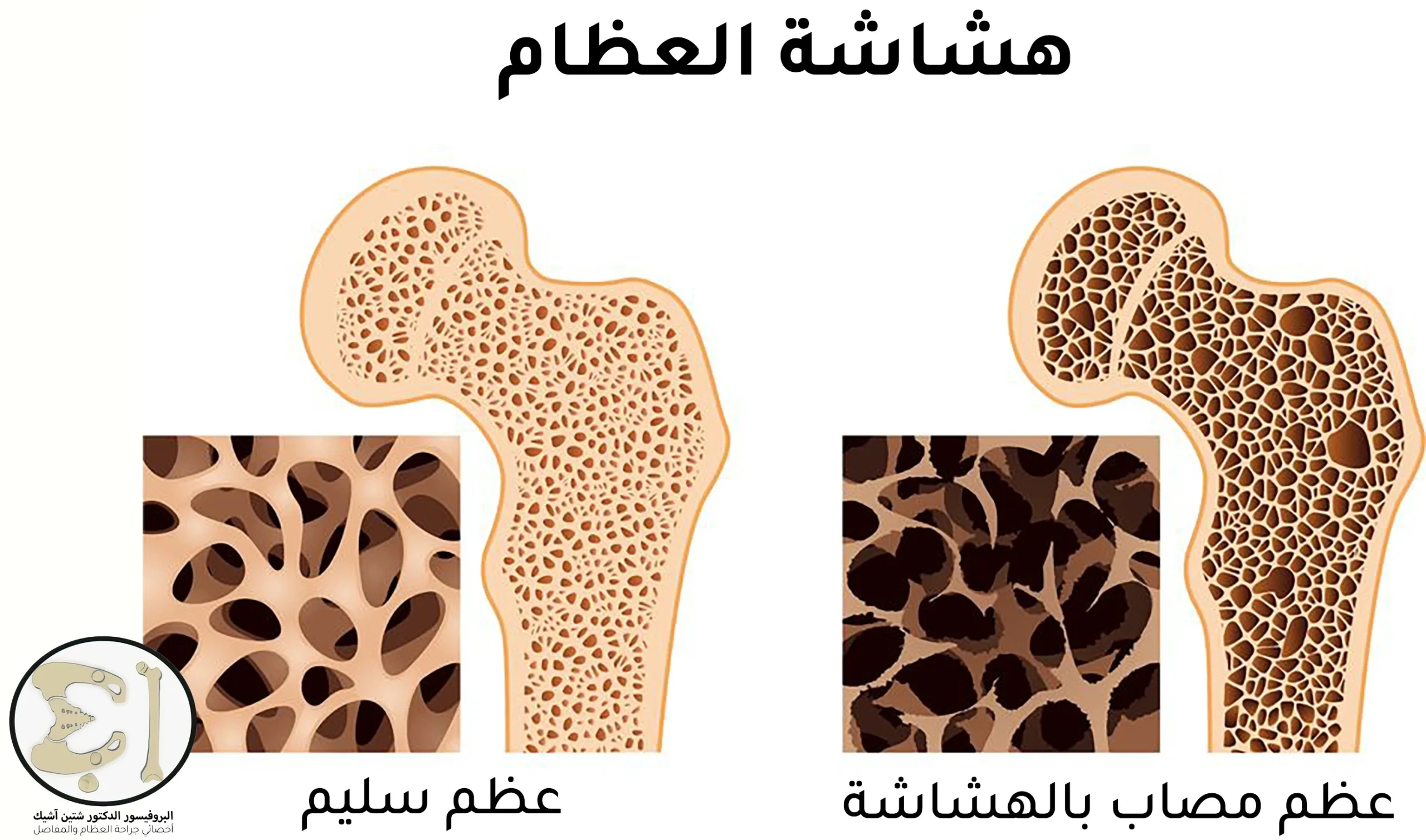 صورة توضح الفرق بين العظم الطبيعي والعظم المصاب بهشاشة العظام
