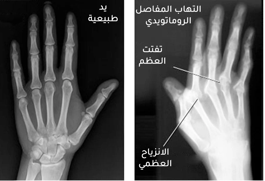 صورة شعاعية توضح الفرق بين اليد السليمة واليد المفاصبة بالتهاب المفاصل الروماتويدي