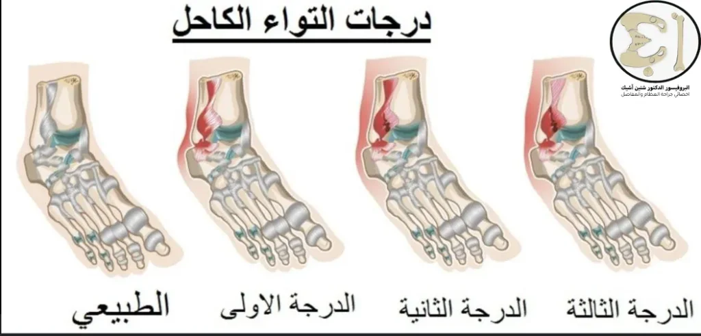 An image showing the degrees of ankle sprain, ranging from a slight stretching of the ligament to a partial tear to a complete tear of the ligament
