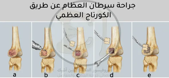 A picture showing the stages of bone cancer treatment using the bone cortage technique