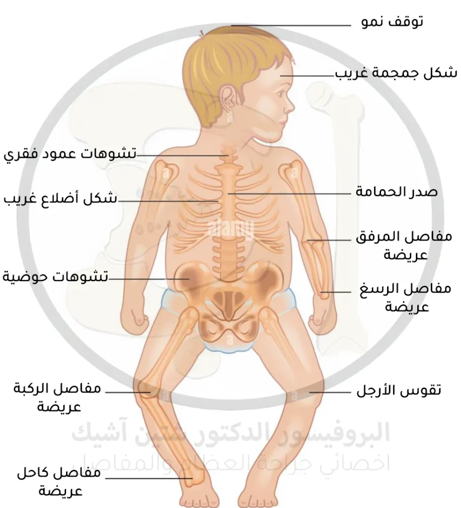 صورة توضح الأعراض المختلفة لطفل مصاب بالكساح مثل العظام المقوسة وشكل العظام الغريب وزيادة في عرض المفاصل والتشوهات الهيكلية المرافقة
