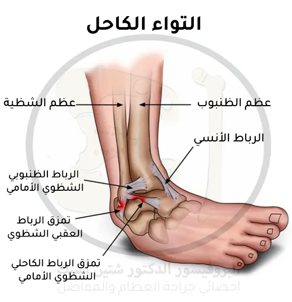 Image showing a sprained and ruptured ankle joint of the calcanofibular and anterior talofibular ligaments that lie lateral to the ankle