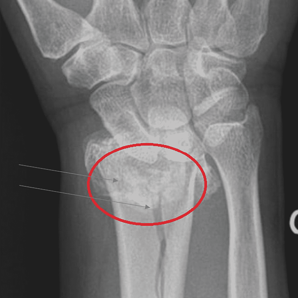 Radiograph showing osteoarthritis of the hand