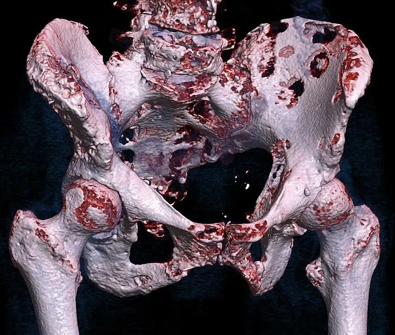 A three-dimensional image of a metastatic bone cancer in the pelvis