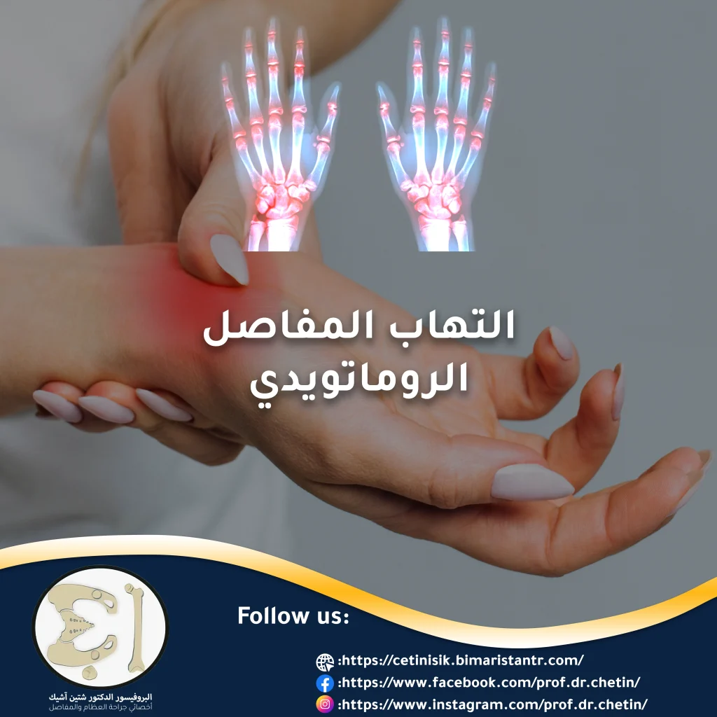 صورة توضح التهاب المفاصل الروماتويدي في الأصابع