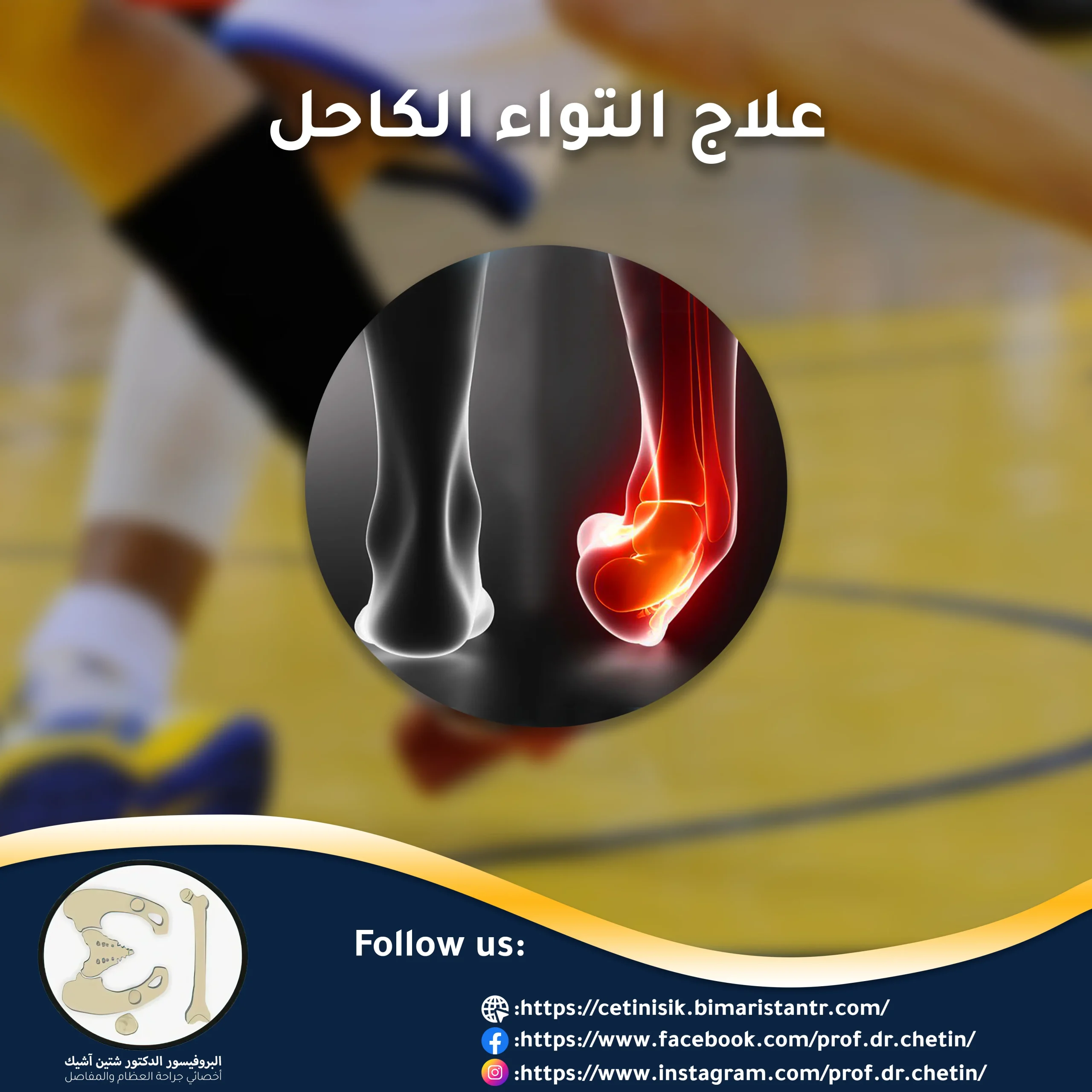 Ankle sprain treatment