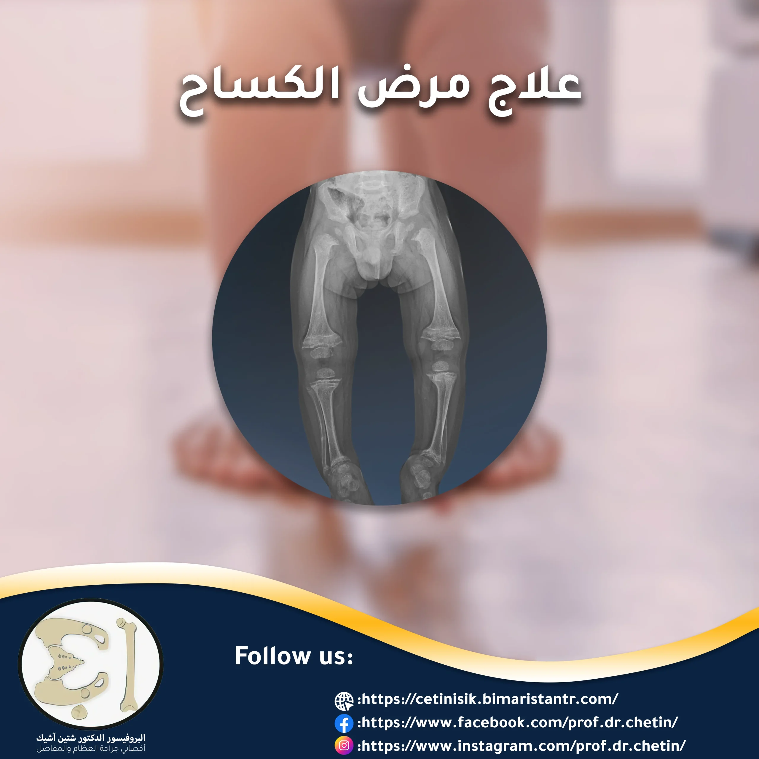 Definitive treatment of rickets