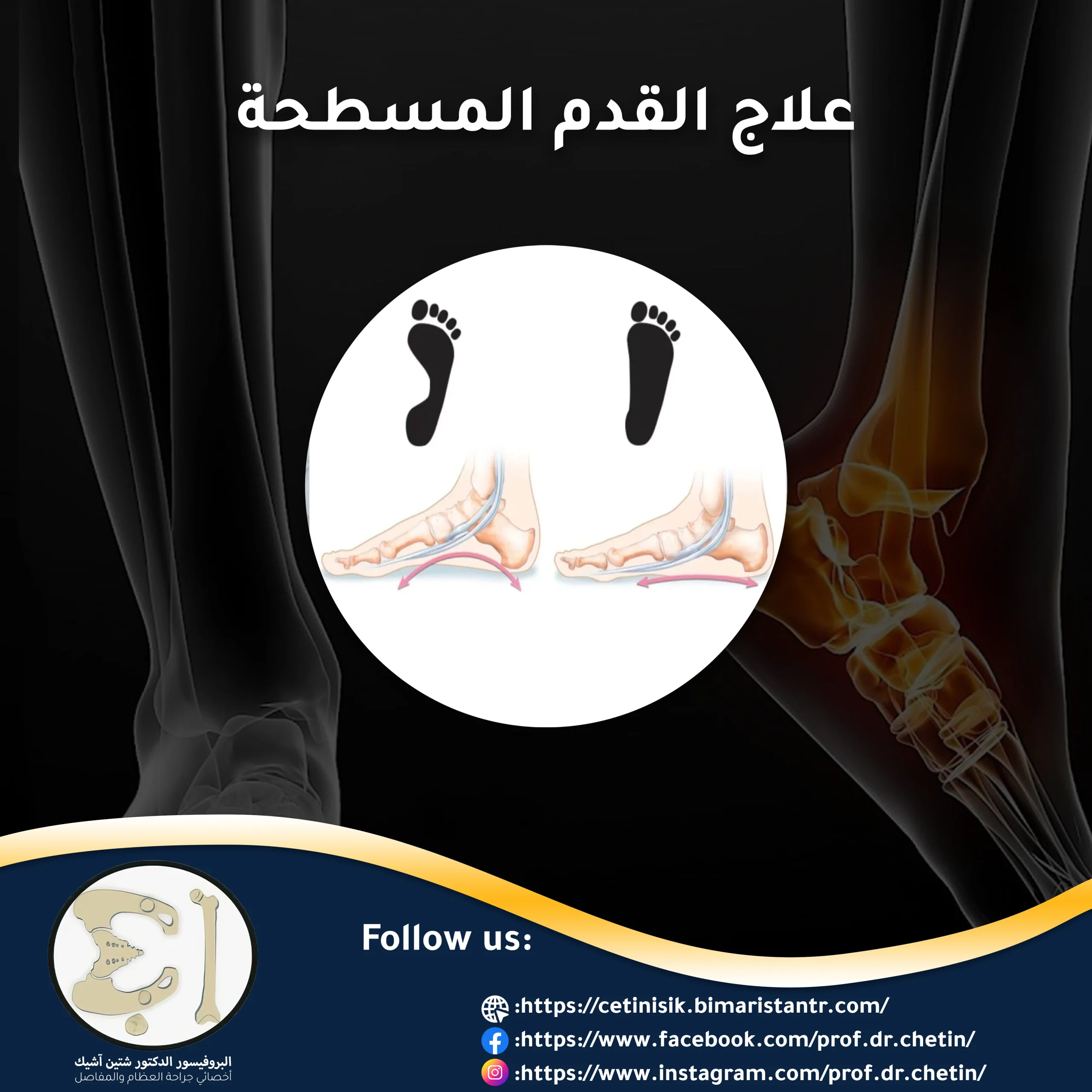 Diagnosis and treatment of flat feet