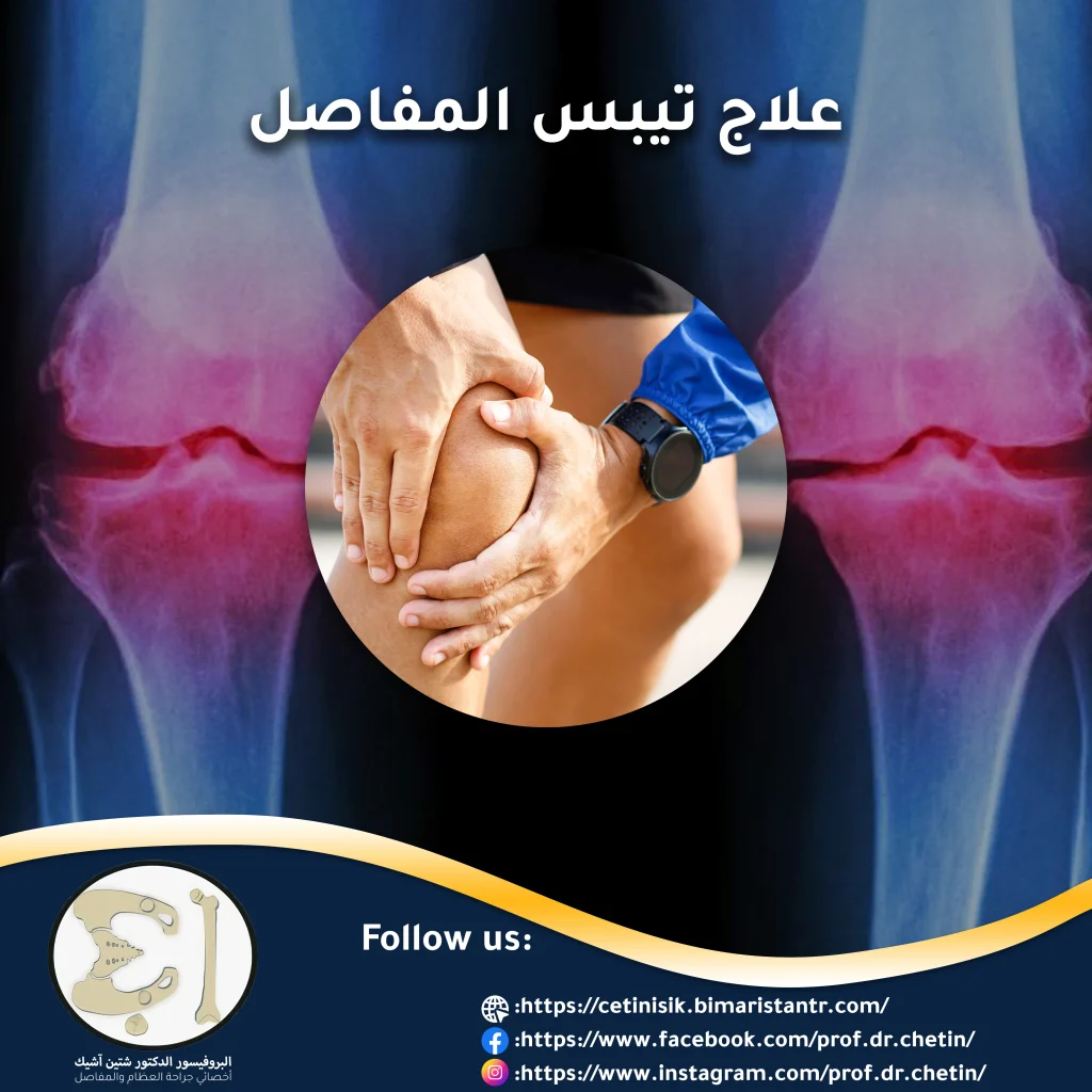Treatment for stiff joints