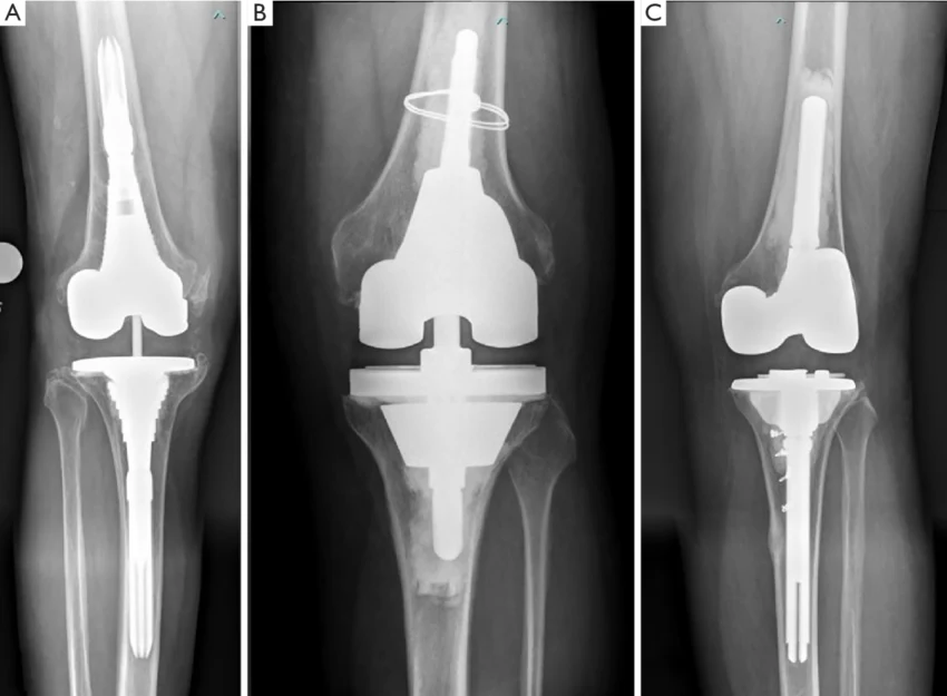 X-ray image of the artificial knee joint in its normal position