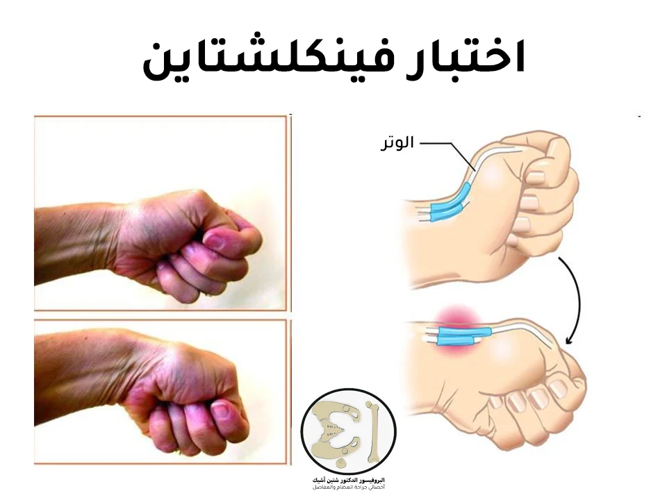 Finkelstein test for thumb tendinitis