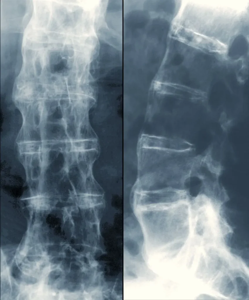 تظهر الأشعة السينية لمريض التهاب الفقار اللاصق الطعم العظمي بين الفقرات من أجل عملية الاندماج
