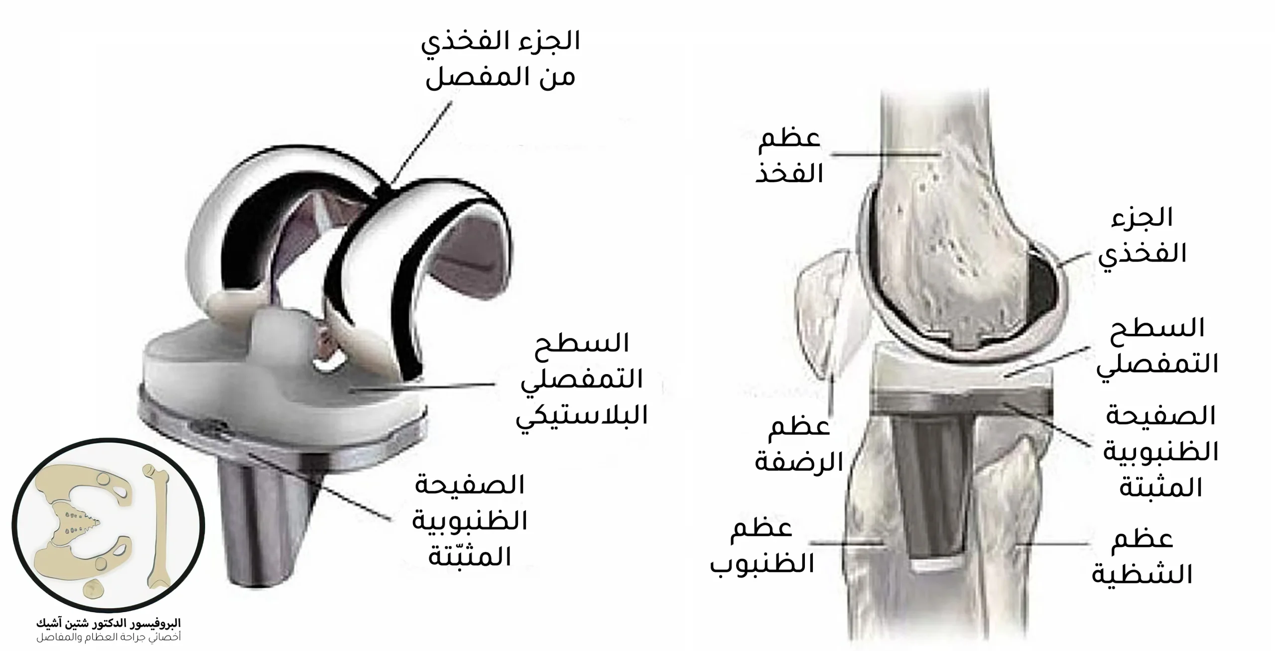 صورة توضح بنية افضل أنواع المفاصل الصنعية للركبة