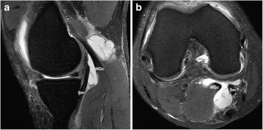 تظهر الصورة كيس خلف الركبة بالرنين المغناطيسي MRI ونلاحظ تجمع السائل الزليلي باللون الأبيض.