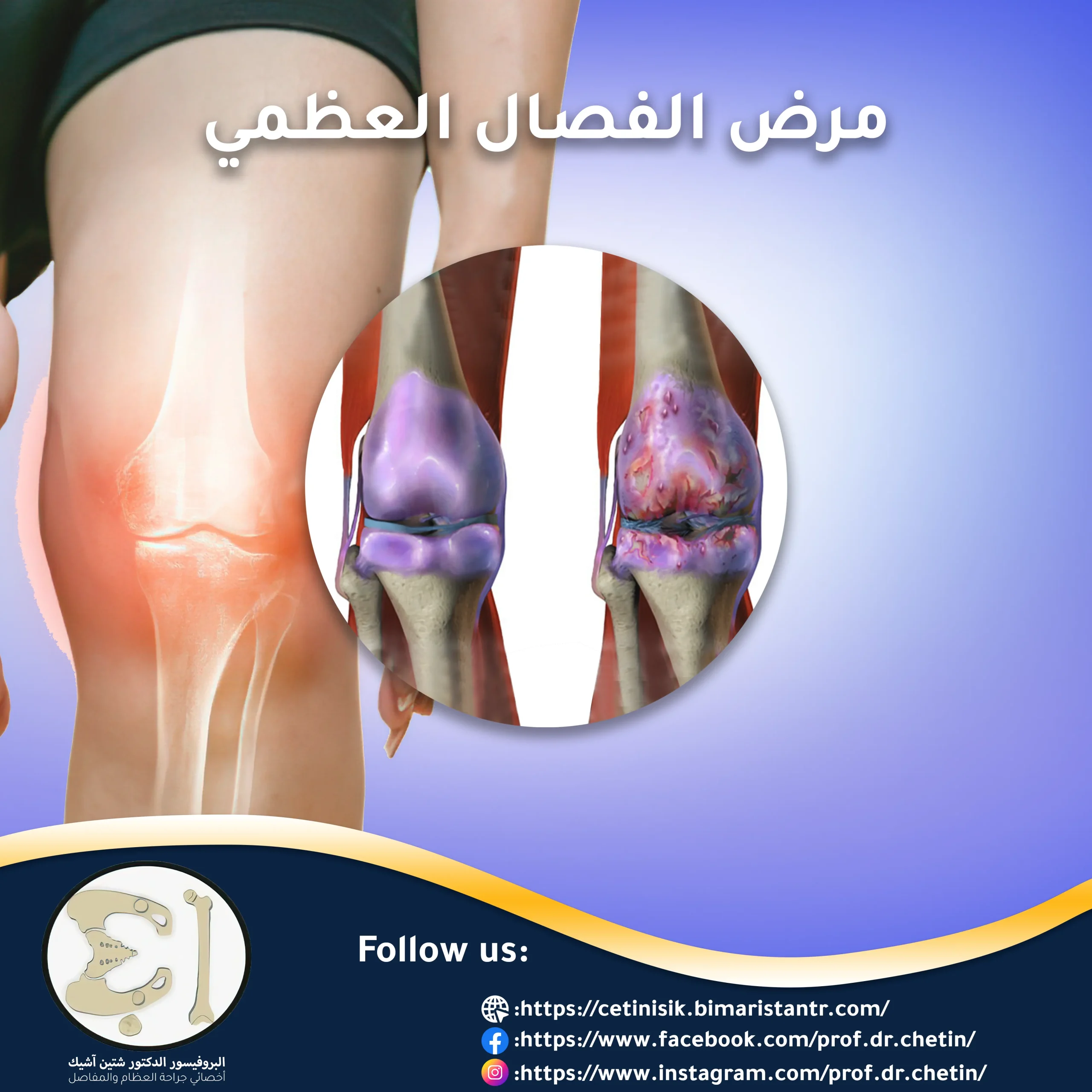 All you need to know about osteoarthritis