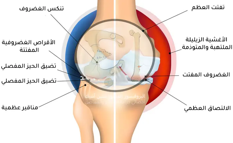 صورة توضح المفصل المصاب بمرض الفصال العظمي