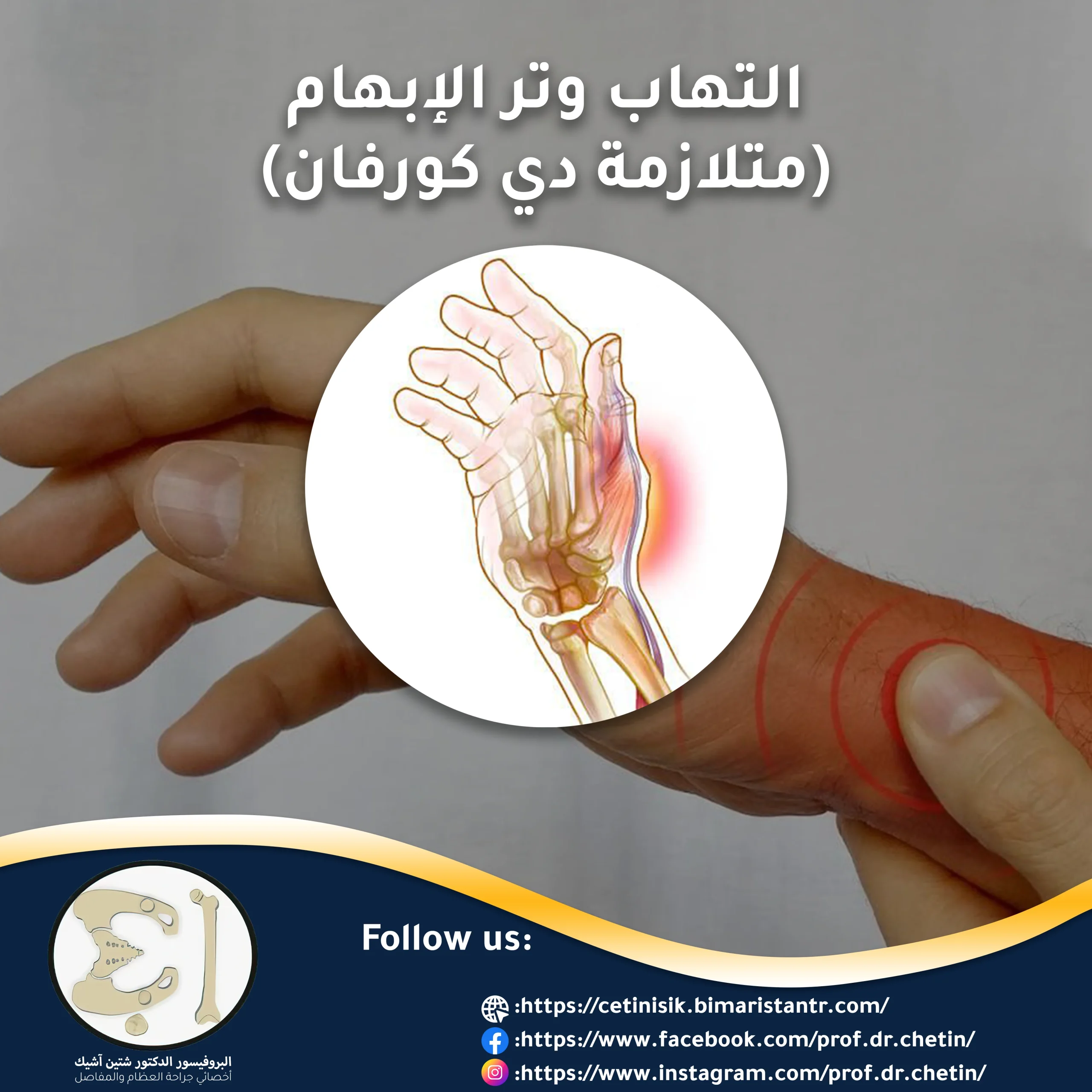 Thumb tendinitis (de Quervain's syndrome)