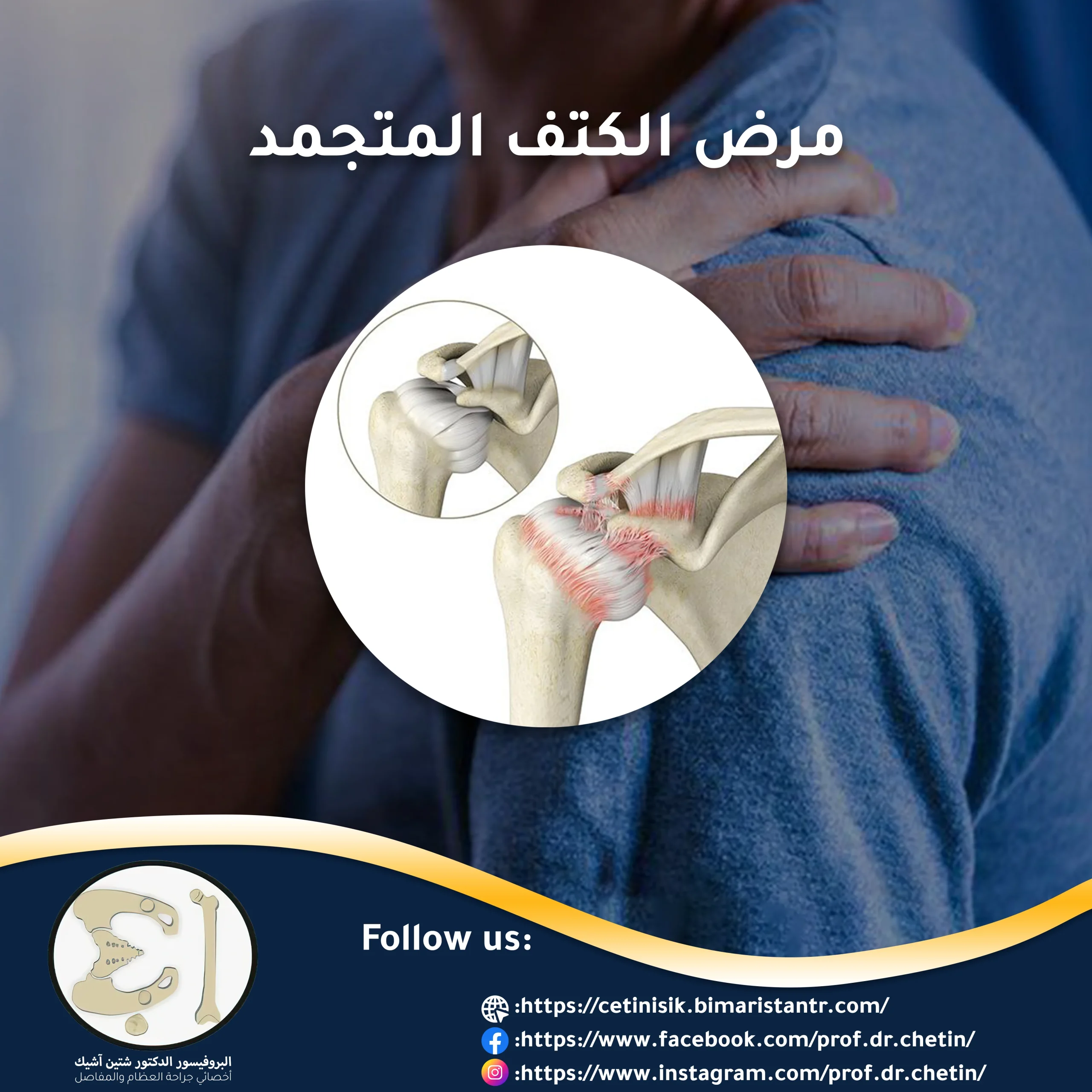 Methods of treating frozen shoulder disease; Symptoms and causes