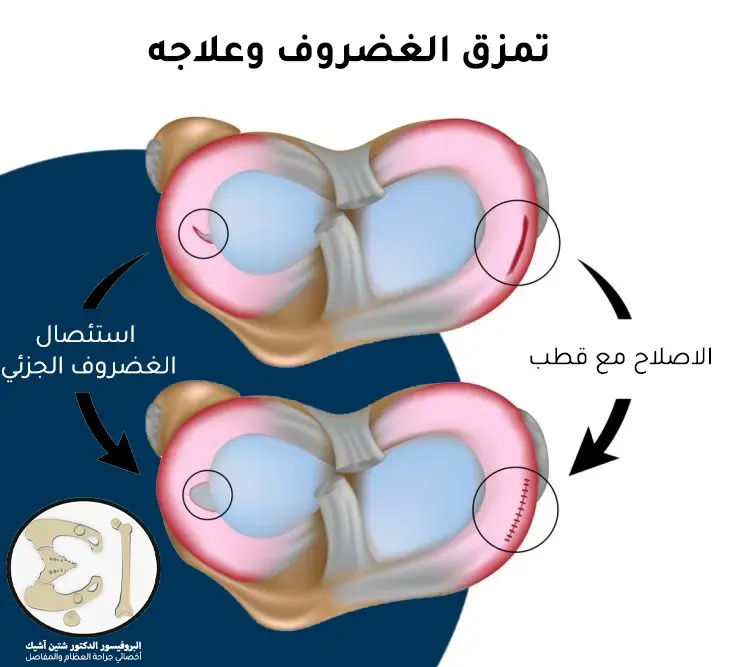 صورة توضح التقنيات الجراحية المستخدمة في إصلاح الغضروف الهلالي قهناك خياطة بقطب وخياطة بدون قطب