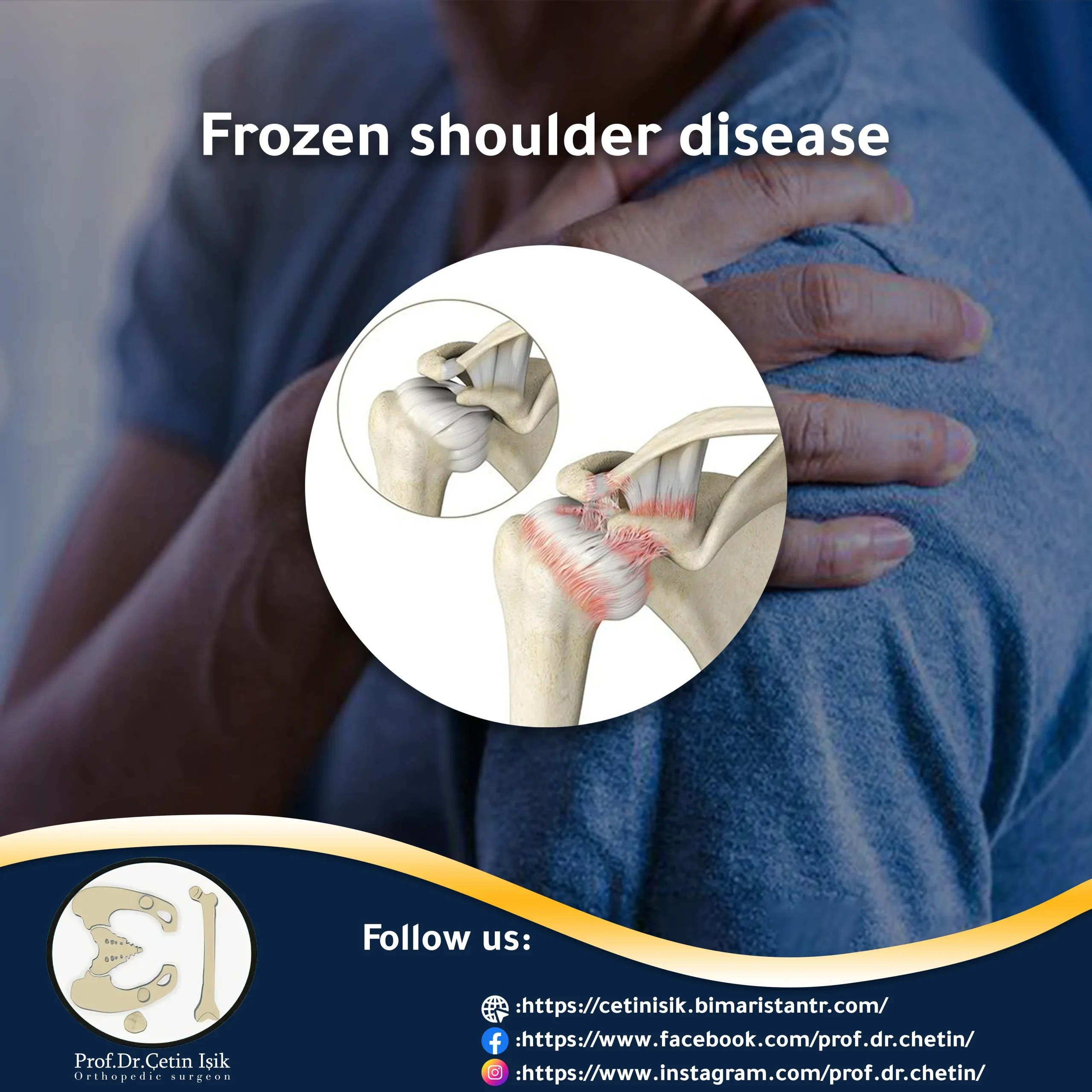 Methods of treating frozen shoulder disease; Symptoms and causes - Dr ...